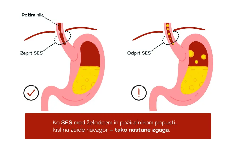 Anatomska infografika delovanja požiralnika pri GERB in zgagi.